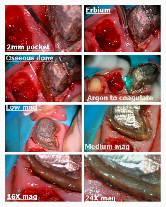 Resize of Resize of Osseous recontouring with bridge pt 3.jpg